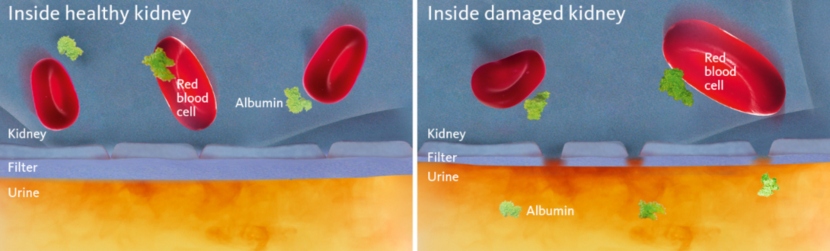 [.ES-es Spain (spanish)] •	Schematic and simplified view of a healthy and a damaged kidney membrane with the latter illustrating the cause of albuminuria.