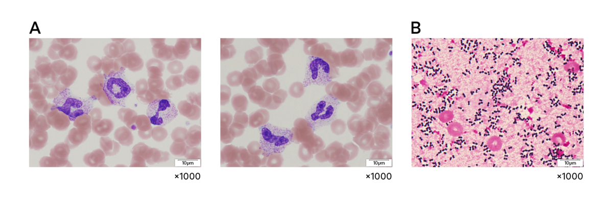 Fig. 3 (A) El frotis de sangre periférica del paciente mostraba granulación tóxica de neutrófilos. (B) El hemocultivo (tinción de Gram) dio positivo en Staphylococcus aureus.