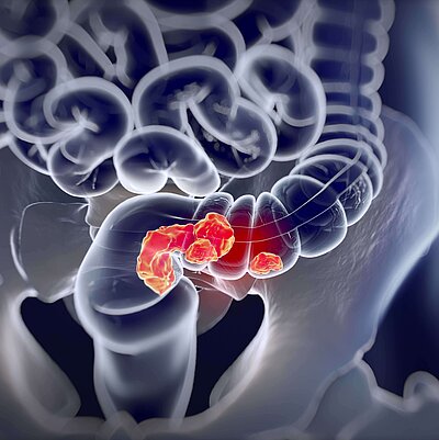 Cáncer colorrectal: métodos de detección e importancia del cribado poblacional