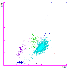 Fig. 2 Diagrama de dispersión WDF que muestra una posición de neutrófilos desplazada hacia arriba y la presencia de granulocitos inmaduros (azul oscuro).