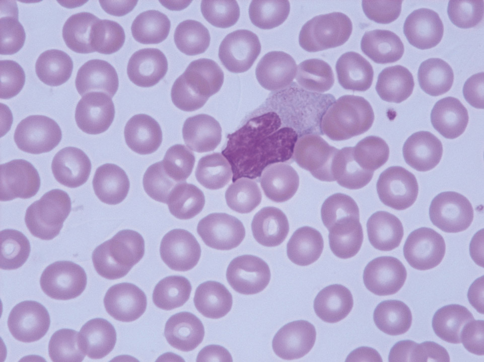 Blood film with staining artefact