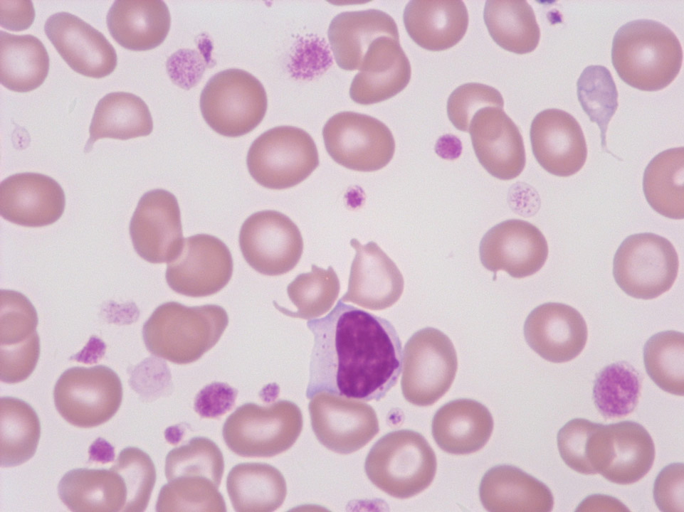 Thrombocytosis, anisocytosis of platelets and giant platelets