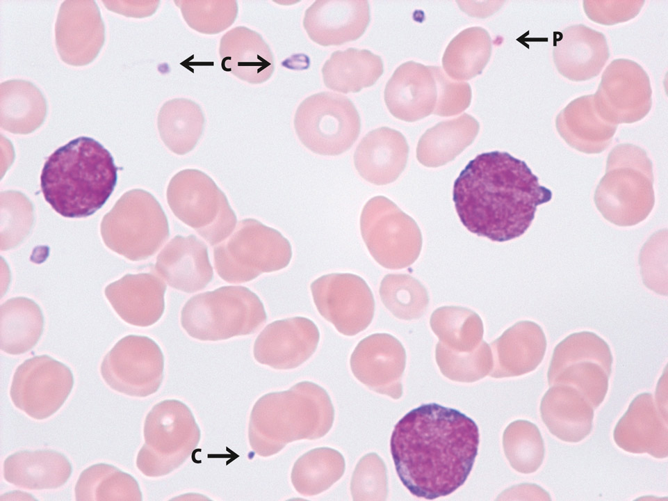 Thrombocytopenia and detection of cytoplasm fragments from monoblasts