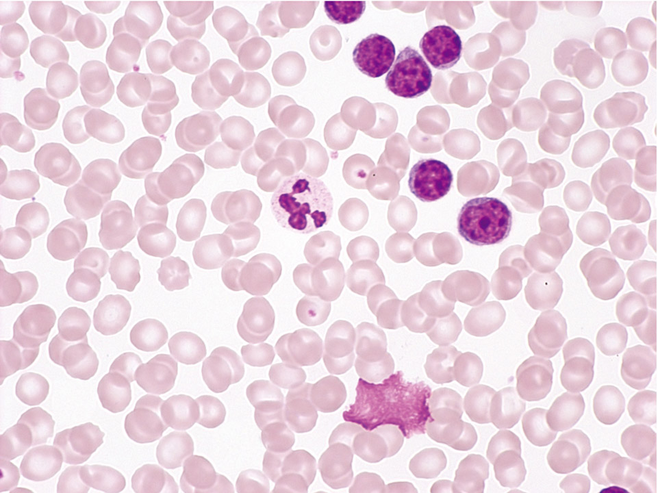 Peripheral blood showing a typical B-CLL