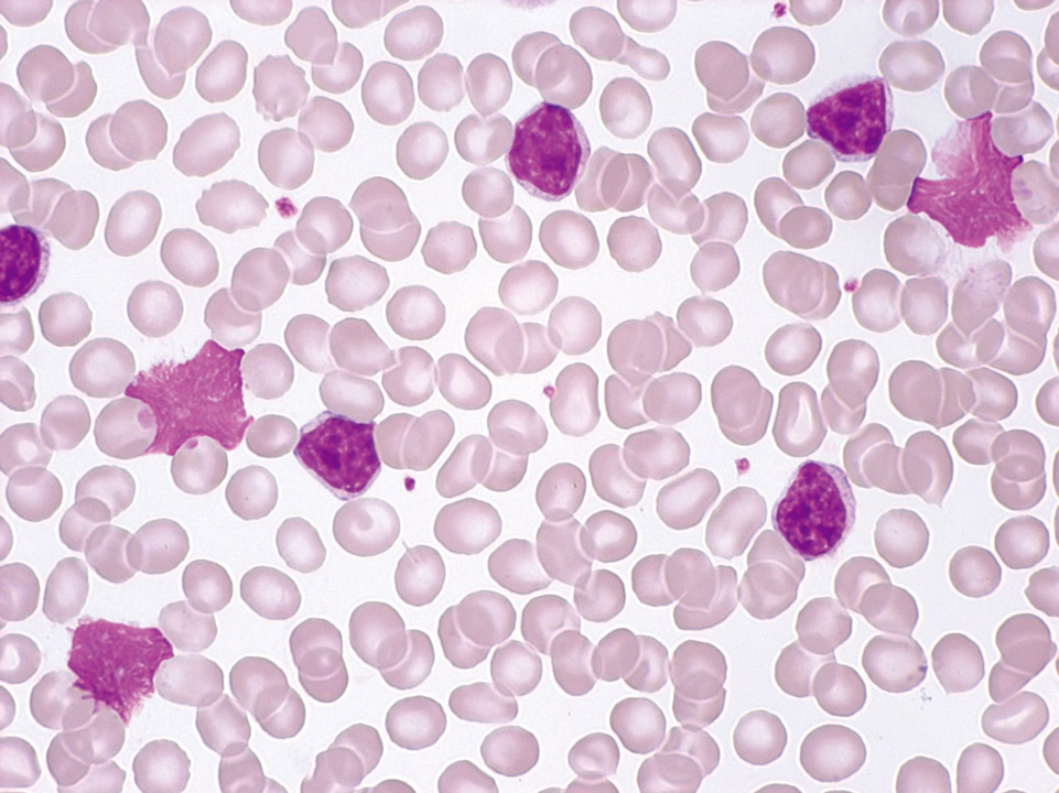 B-CLL with granulocytopenia