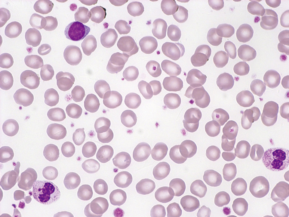 Peripheral blood of a patient with ET showing an isolated thrombocytosis