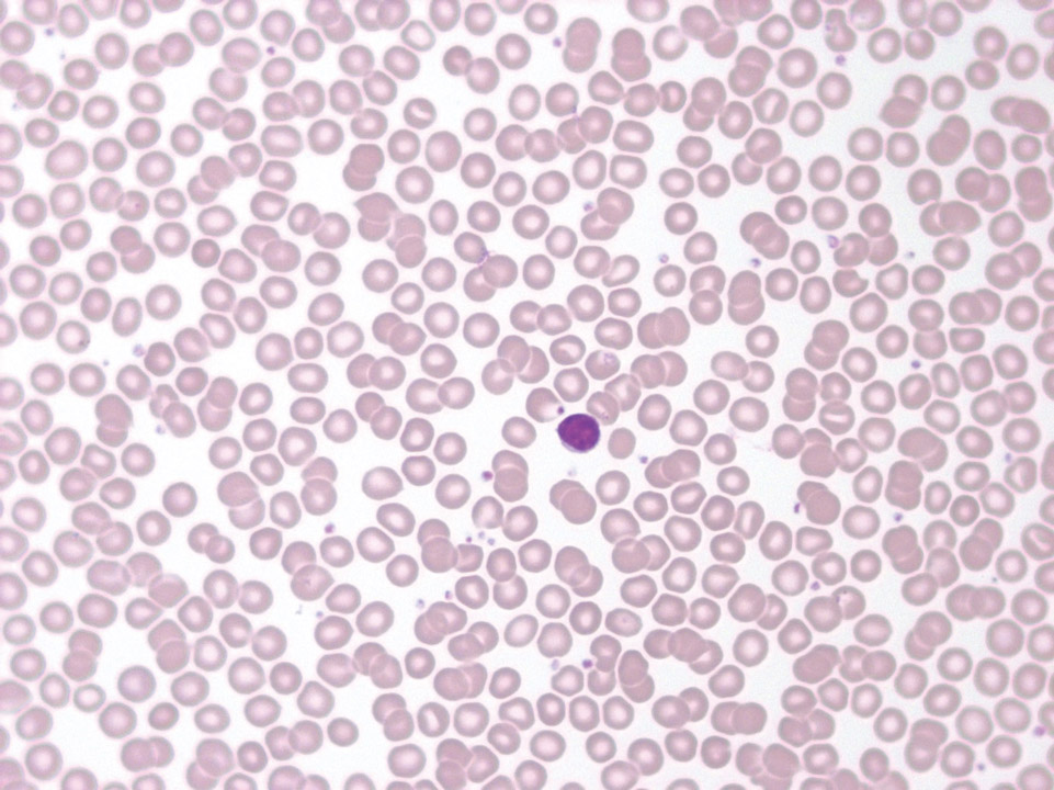 Peripheral blood of a patient showing isolated neutropenia