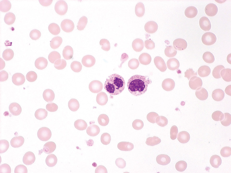 Peripheral blood of a patient with MDS