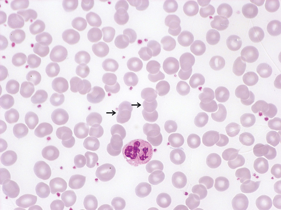 'Rouleaux formation' in blood of a patient with chronic polyarthritis