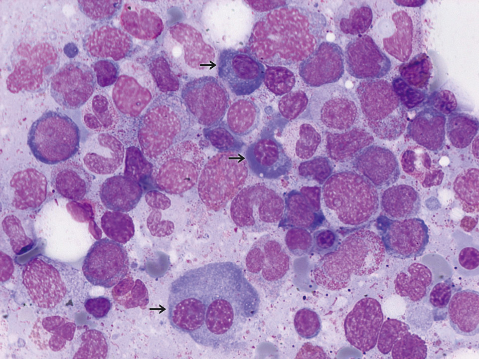 Bone marrow cytology of a patient with CMML