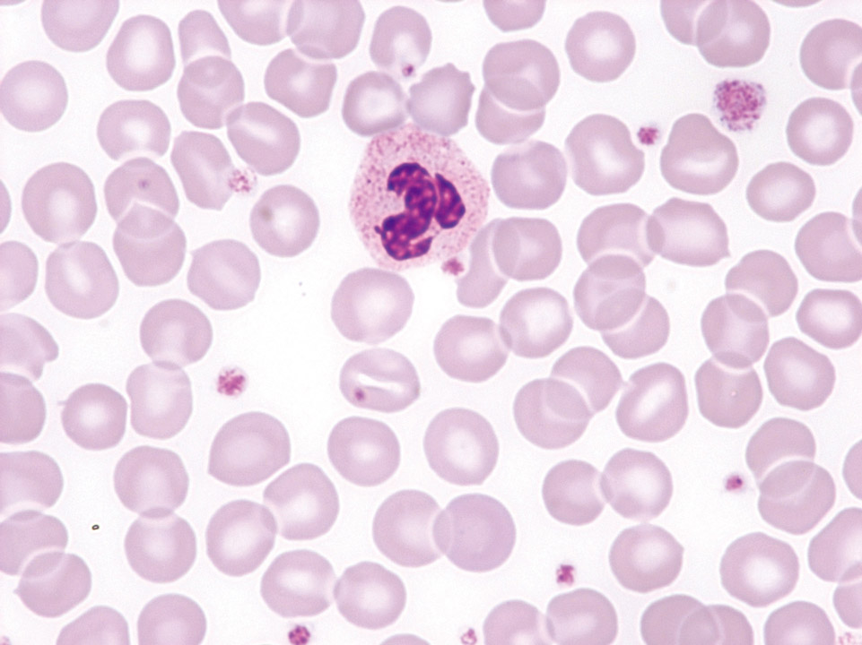 Increase of all three cell lineages in peripheral blood of a patient with PV