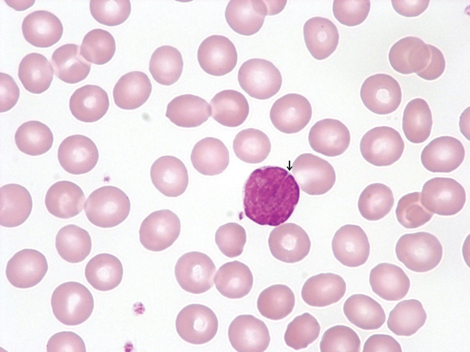 Lymphoma cells in peripheral blood