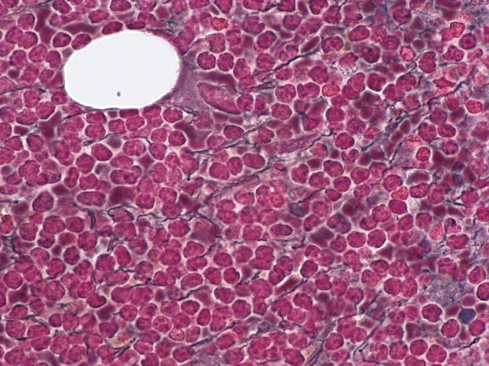Mantle cell lymphoma infiltrating bone marrow